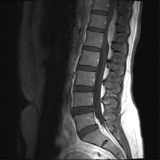 Epidural angiolipoma | Image | Radiopaedia.org