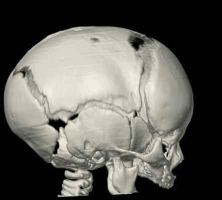 Scaphocephaly | Radiology Case | Radiopaedia.org