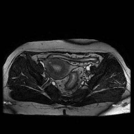 Inflammatory Bowel Disease (MR Enterography) | Image | Radiopaedia.org