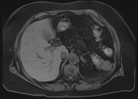 Mass-forming intrahepatic cholangiocarcinoma | Image | Radiopaedia.org