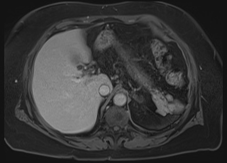 Cholangiocarcinoma Radiopaedia