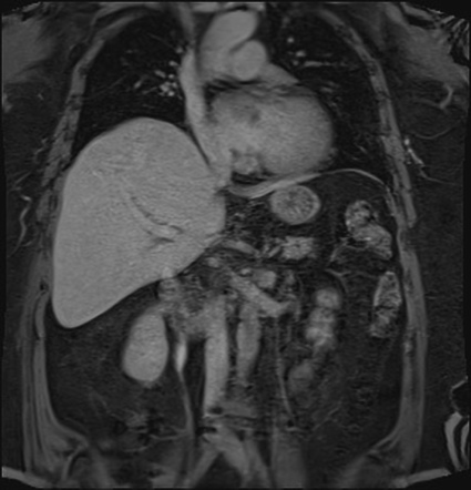 Mass Forming Intrahepatic Cholangiocarcinoma Image Radiopaedia Org