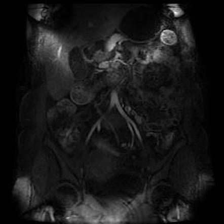 Inflammatory Bowel Disease (MR Enterography) | Image | Radiopaedia.org