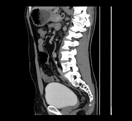 Crossed fused renal ectopia | Image | Radiopaedia.org