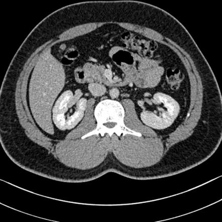 Normal kidneys on 4-phase CT study | Image | Radiopaedia.org