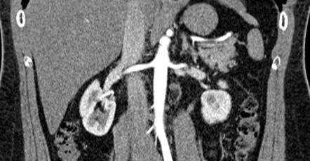 Renal artery | Radiology Reference Article | Radiopaedia.org