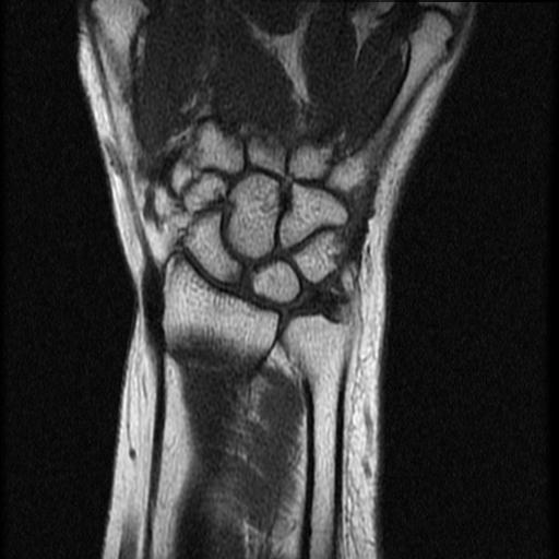 Partial-thickness tear of the fifth extensor digitorum tendon | Image ...