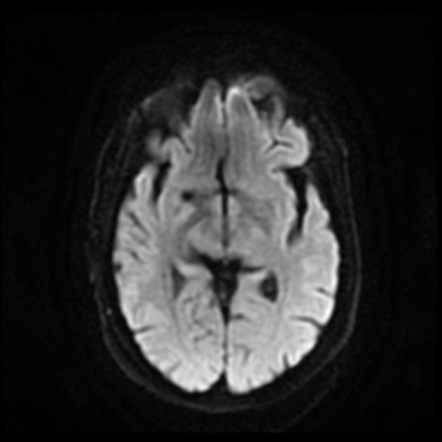 Cerebellar cavernoma | Image | Radiopaedia.org