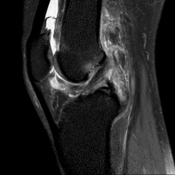 Spontaneous osteonecrosis of the knee | Image | Radiopaedia.org