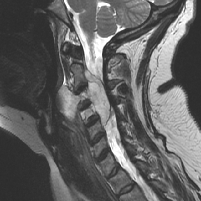 Chordoma - cervical spine | Image | Radiopaedia.org