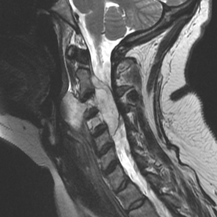 Chordoma - cervical spine | Radiology Case | Radiopaedia.org