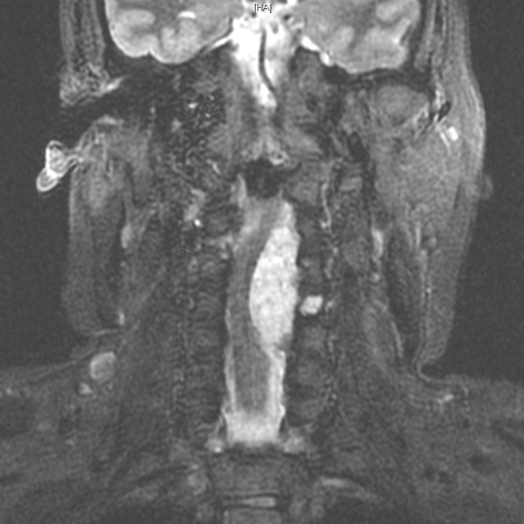 Chordoma - cervical spine | Image | Radiopaedia.org