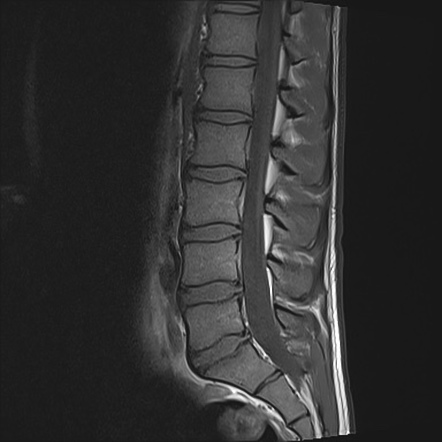 Pars defect - T1 VIBE sequence (MRI) | Image | Radiopaedia.org