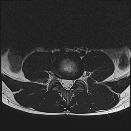 Pars defect - T1 VIBE sequence (MRI) | Image | Radiopaedia.org