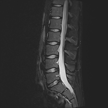 Pars defect - T1 VIBE sequence (MRI) | Image | Radiopaedia.org