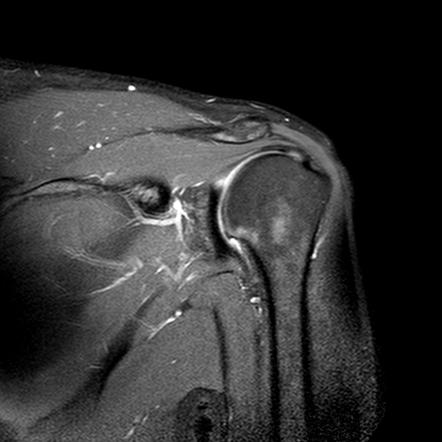 POLPSA lesion | Image | Radiopaedia.org