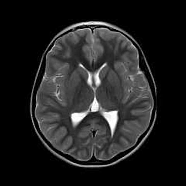 Unilateral cerebellar hypoplasia and cerebellar cleft associated