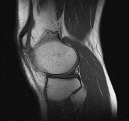 Patellar tendon-lateral femoral condyle friction syndrome | Image ...