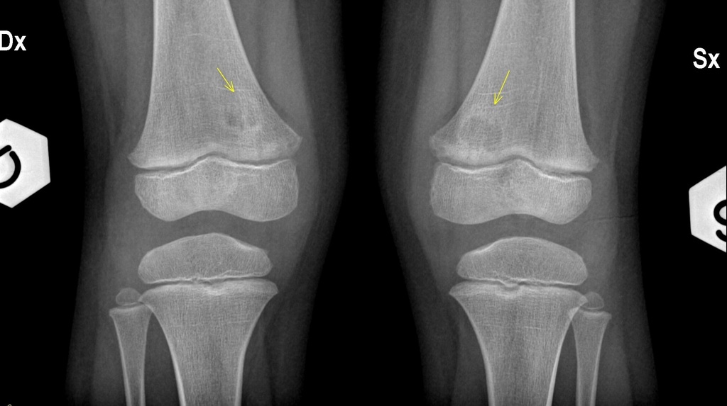 Periosteal Desmoid Radiology Case Radiopaedia Org