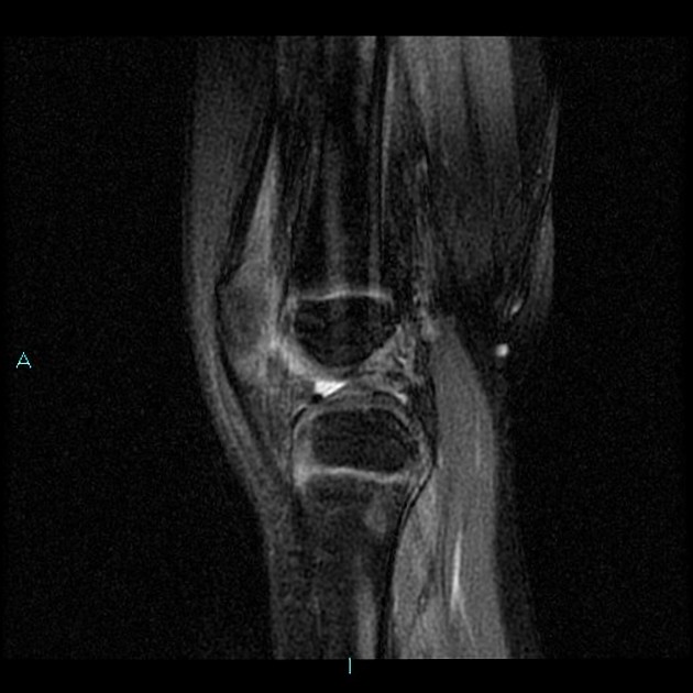 Periosteal Desmoid Radiology Case Radiopaedia Org