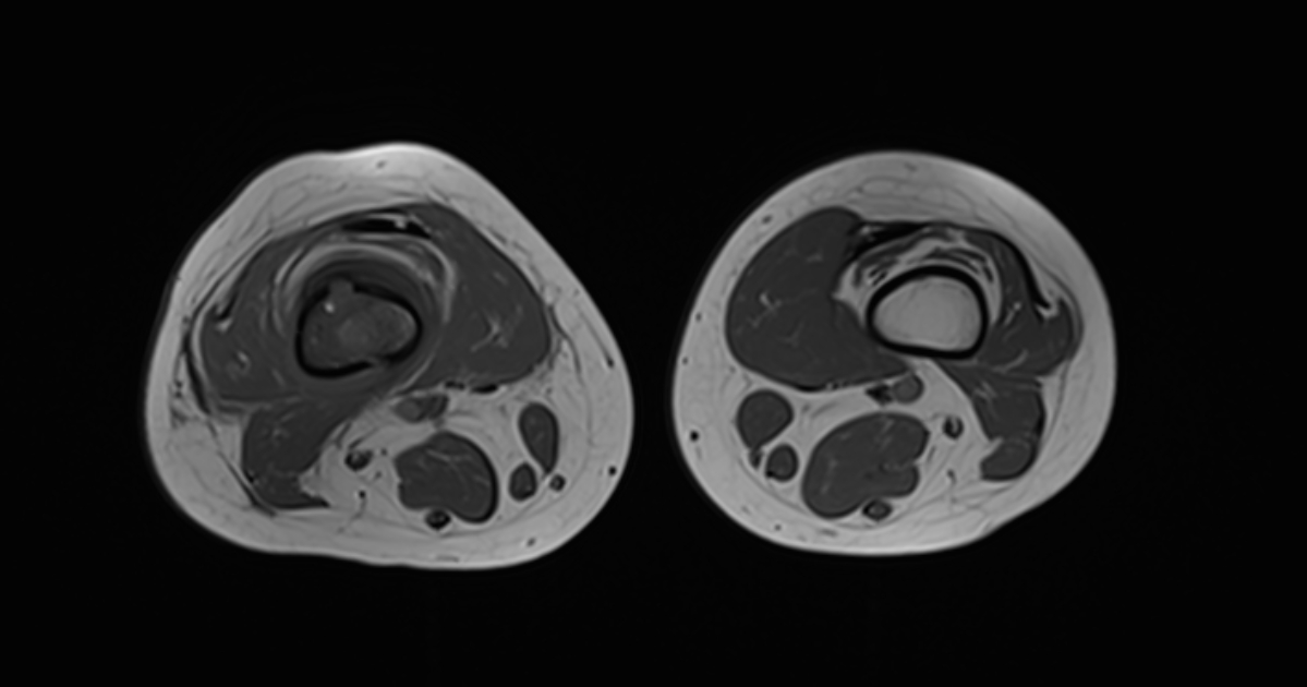 Osteomyelitis Femur Image