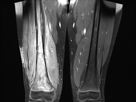 Osteomyelitis Femur Radiology Case Radiopaedia Org