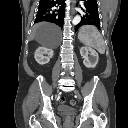 Adrenal cyst | Radiology Case | Radiopaedia.org