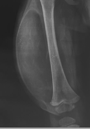 Large lipoma - thigh | Radiology Case | Radiopaedia.org