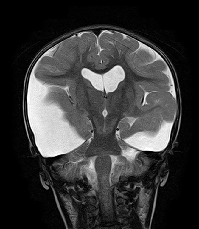 Bilateral Temporal Arachnoid Cysts Type Iii Image