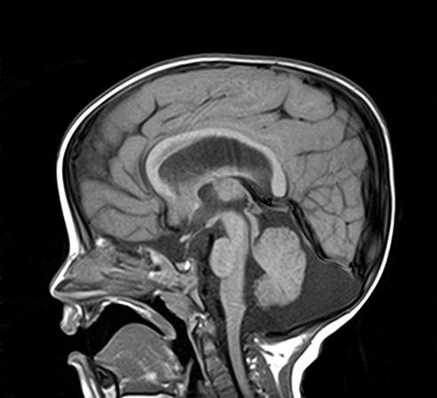 Bilateral temporal arachnoid cysts type III | Image | Radiopaedia.org