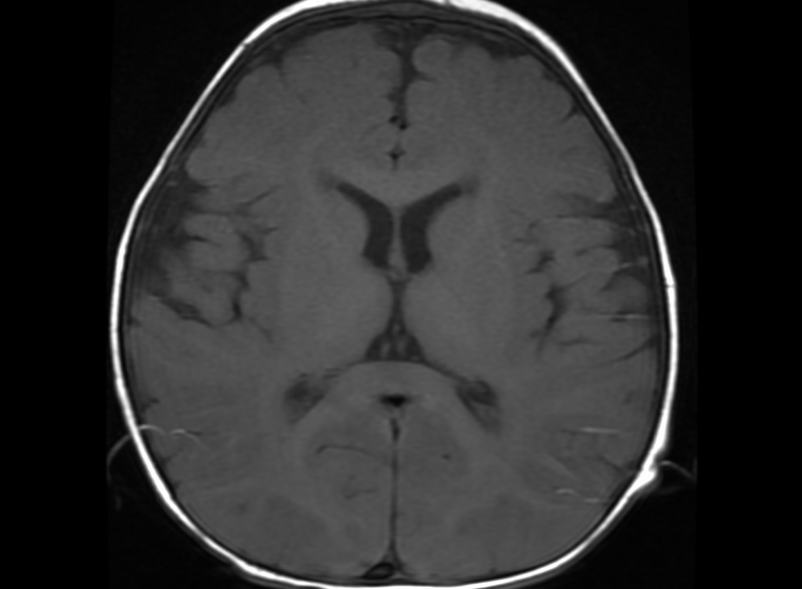 Krabbe disease | Image | Radiopaedia.org