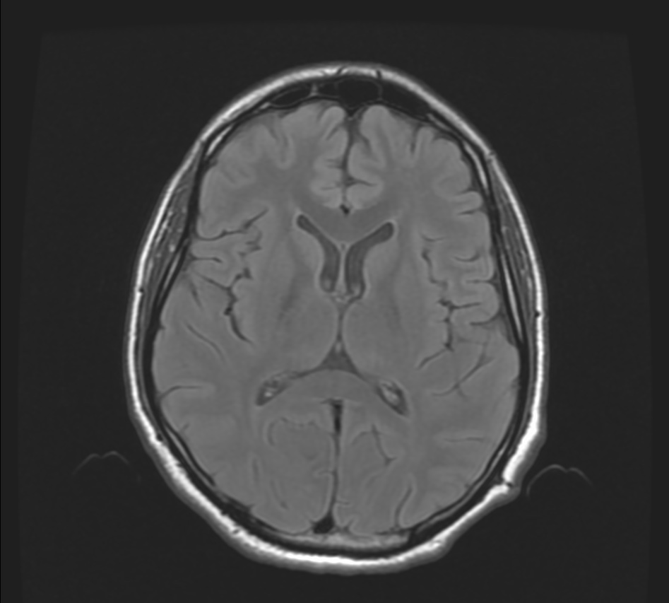 diffuse-axonal-injury-image-radiopaedia