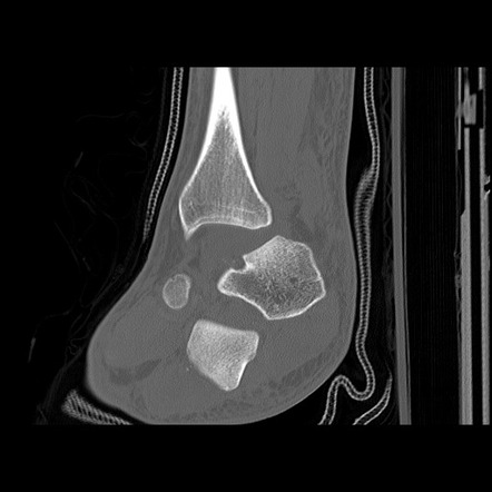 Total talar dislocation | Radiology Reference Article | Radiopaedia.org