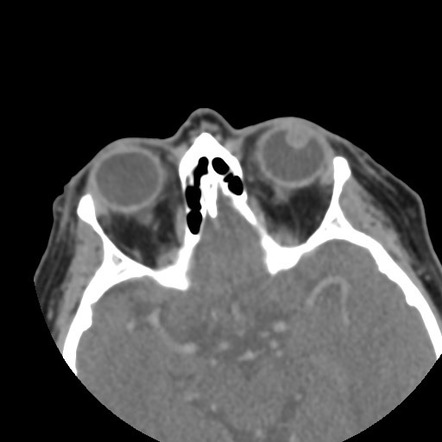 Uveal melanoma | Image | Radiopaedia.org