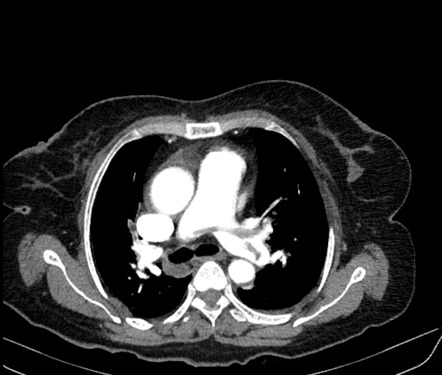 Saddle pulmonary embolus | Radiology Case | Radiopaedia.org