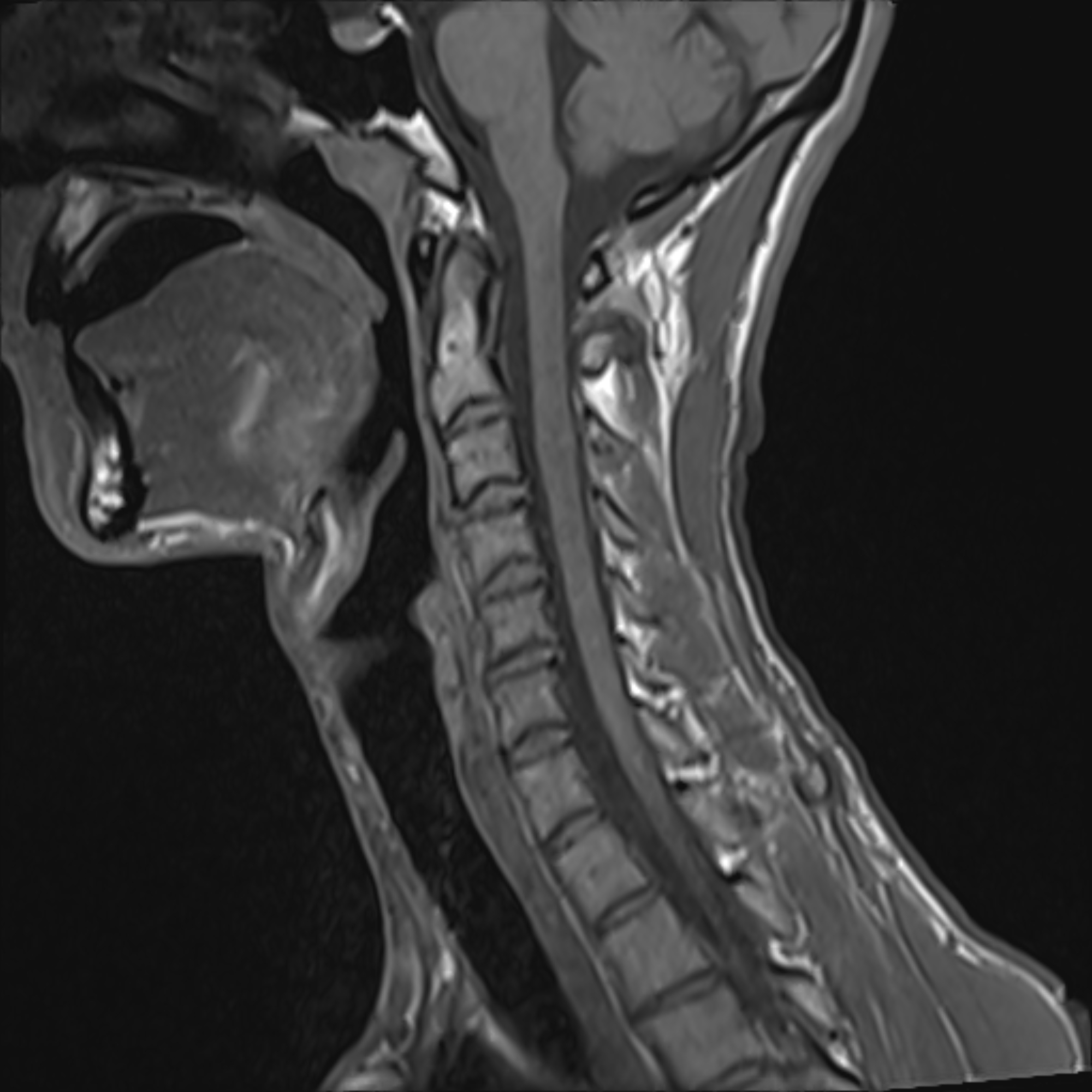 Traumatic spinal cord contusion | Image | Radiopaedia.org