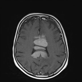 Primary CNS lymphoma (PCNSL) | Image | Radiopaedia.org