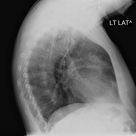 Eosinophilic Granulomatosis With Polyangiitis Image Radiopaedia Org