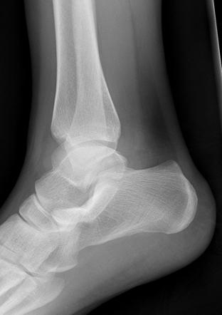 Lateral malleolous-talus false articulation or non-osseous coalition ...