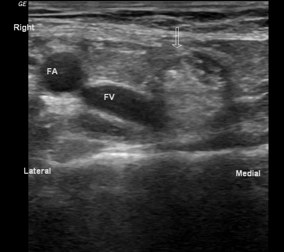 Femoral hernia | Image | Radiopaedia.org