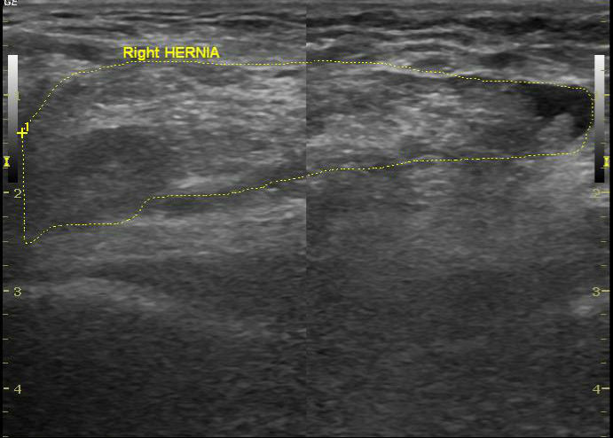 Можно увидеть грыжу на узи