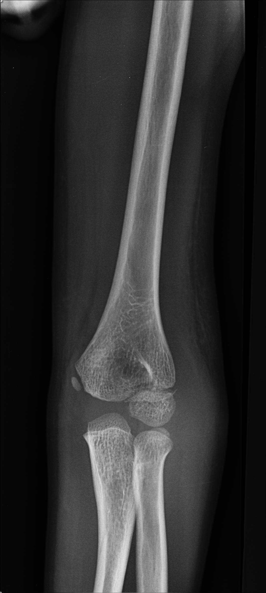 Lateral humeral condylar fracture | Image | Radiopaedia.org