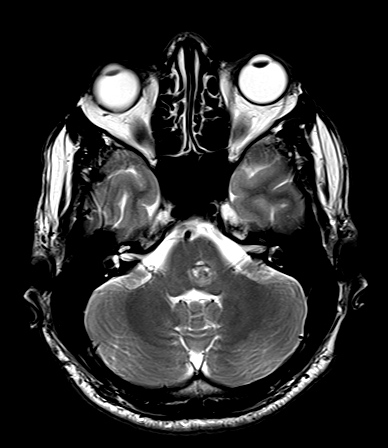 Brainstem cavernoma | Image | Radiopaedia.org