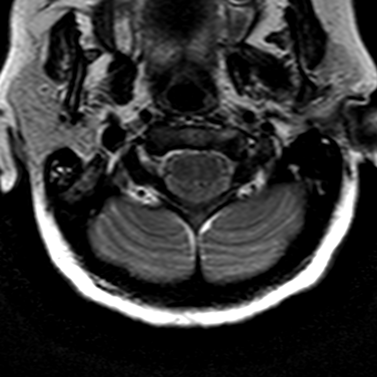 Chiari 1.5 malformation | Image | Radiopaedia.org