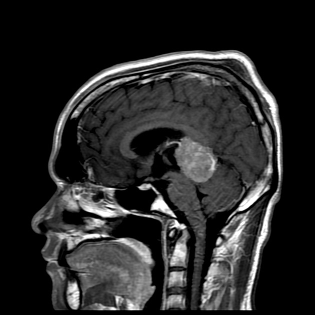 Pineal germinoma | Radiology Reference Article | Radiopaedia.org