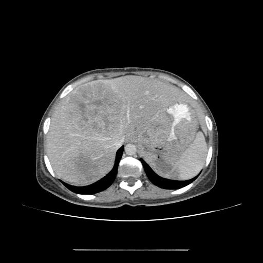 Malignant Gastrointestinal Stromal Tumor Gist Of Stomach Image