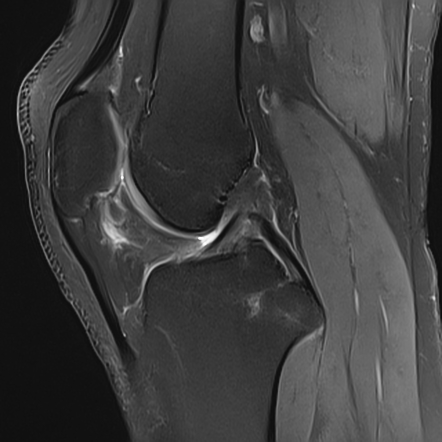 Subacute lateral tibial condyle fracture with floating meniscus ...