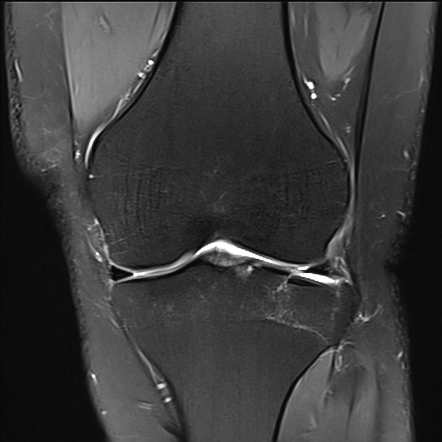 Floating meniscus | Radiology Reference Article | Radiopaedia.org