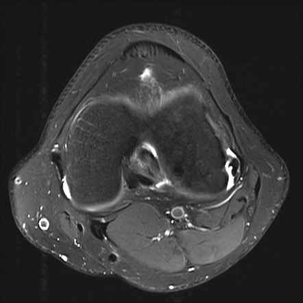 Subacute lateral tibial condyle fracture with floating meniscus | Image ...