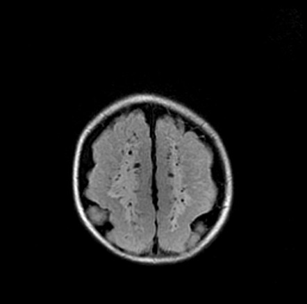 Mucopolysaccharidosis Type I | Radiology Case | Radiopaedia.org